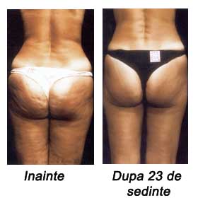 Metode urgente de remodelare