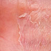 Cea mai comuna dermatita
