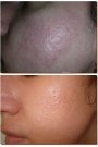 Clinica Dermastyle aduce in Romania Active Laser FX, procedura care