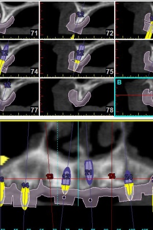 Implantul dentar High Tech, 
tehnici de chirurgie dentara complet