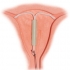 O metoda de contraceptie: Dispozitivul intrauterin