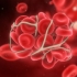 TEV - a treia boala cardiovasculara ca incidenta