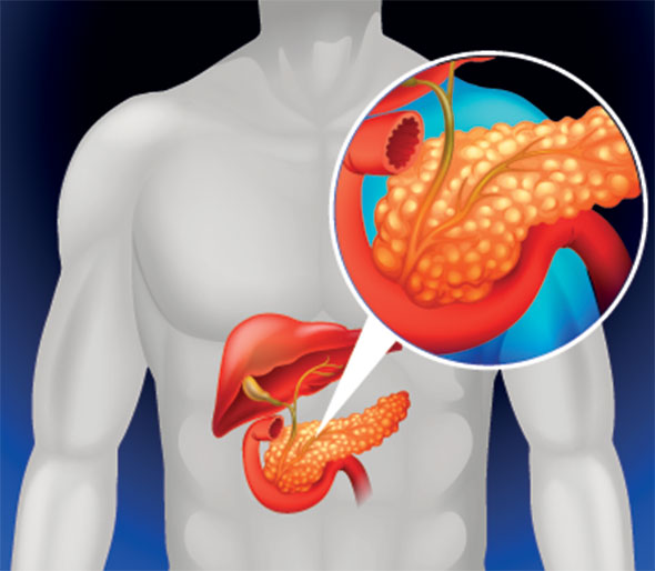 Dieta in bolile pancreatice