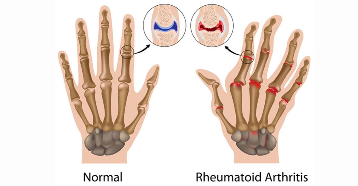artrita și tratamentul artrozei gleznei