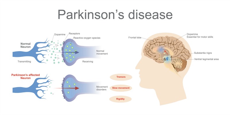 boala Parkinson