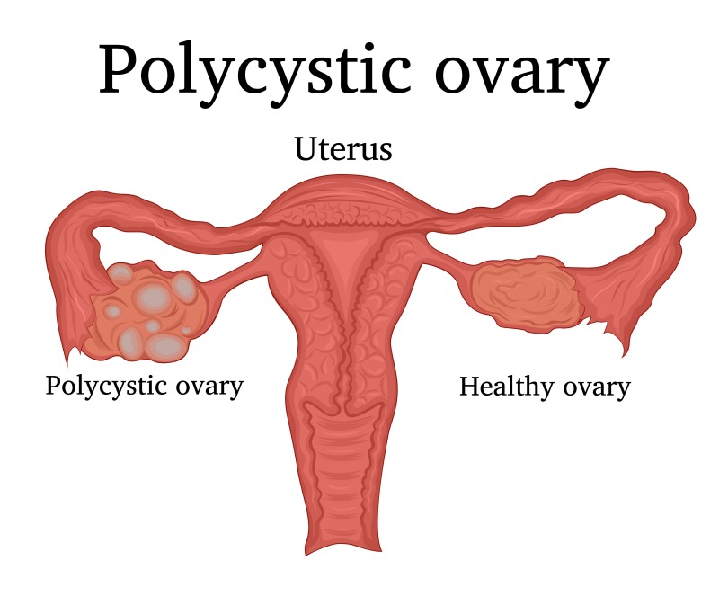 cum să pierdeți greutatea cu ovarele polichistice