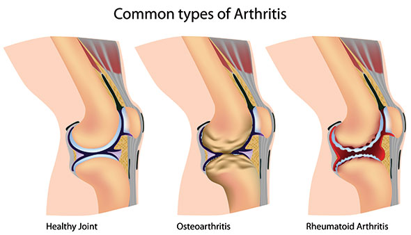 gonartroza deformantă a genunchiului tratament de 1 grad curs de restaurare comună